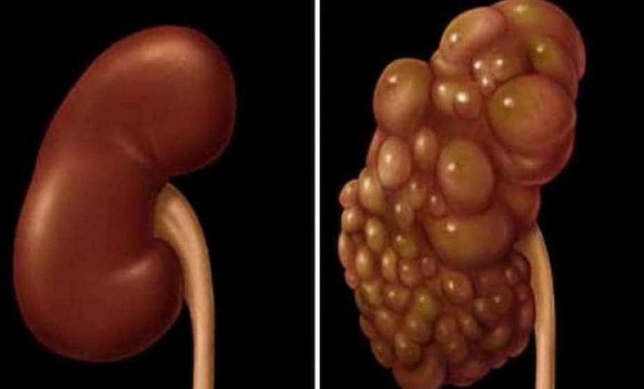 Kidney Cyst: Types, Symptoms and Treatment