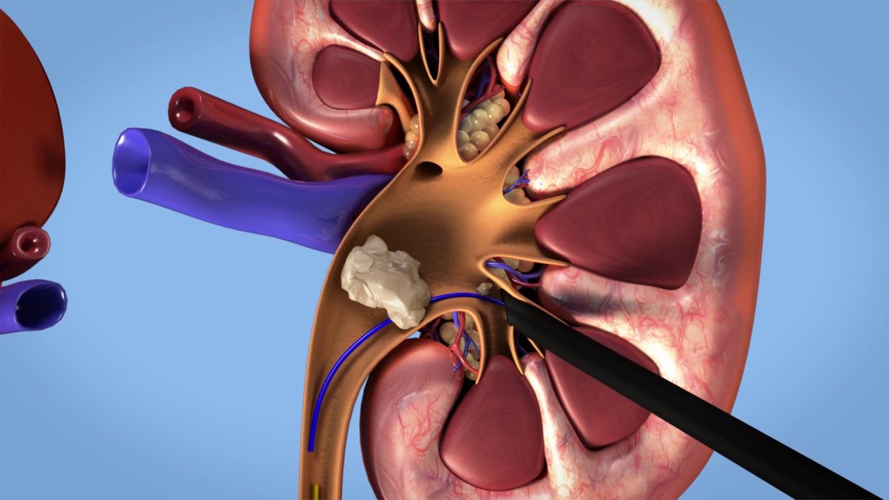 Kidney Stone Surgery: Modern Treatment Methods