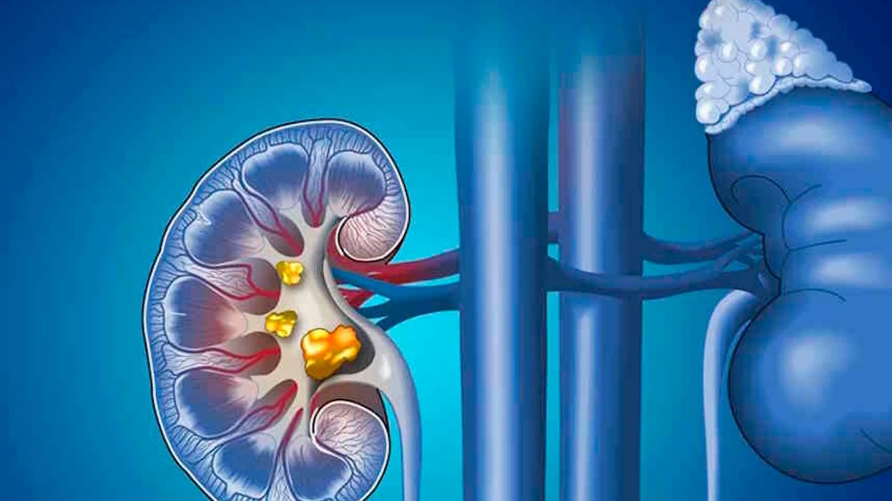 Kidney Stones: Symptoms, Causes and Treatment Methods
