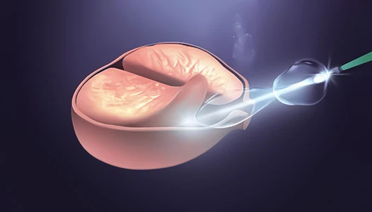 HoLEP (Holmium Laser Prostate Surgery): Gold Standard for Benign Prostate Enlargement