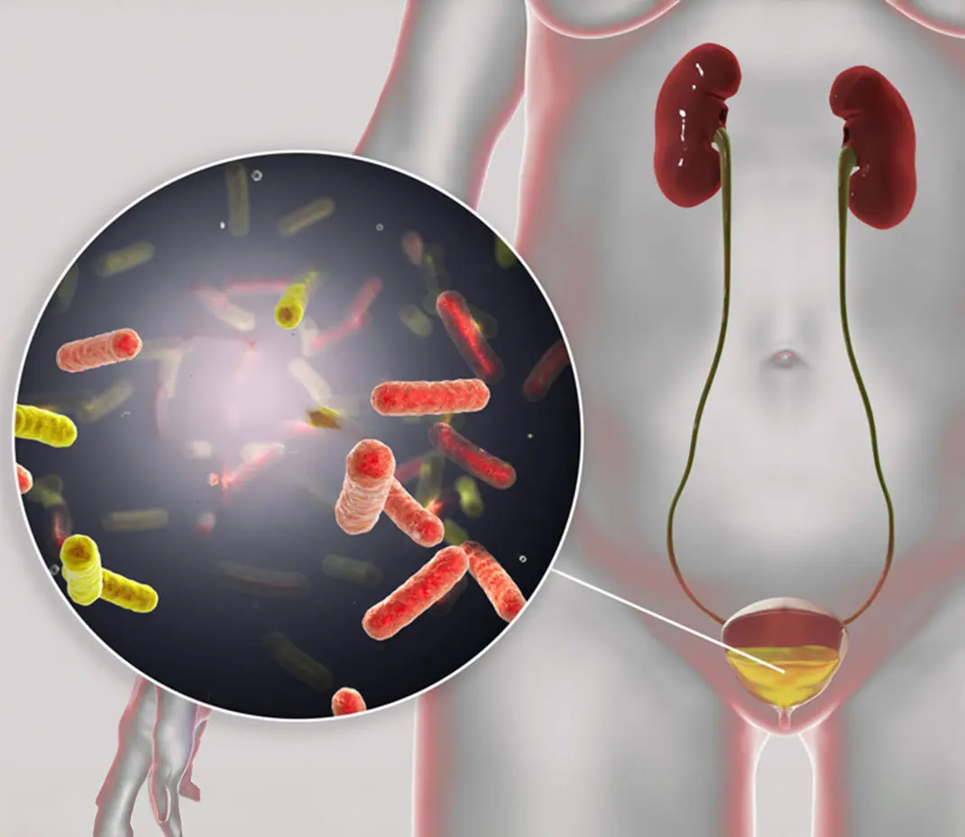 Urinary Tract Infection: Symptoms, Causes and Treatment