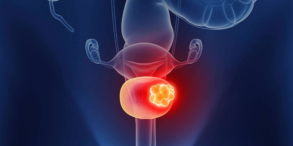 Bladder Cancer: Symptoms, Diagnosis and Treatment Methods