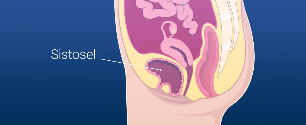 Bladder Prolapse (Cystocele) and Pelvic Organ Prolapse: Symptoms and Treatment