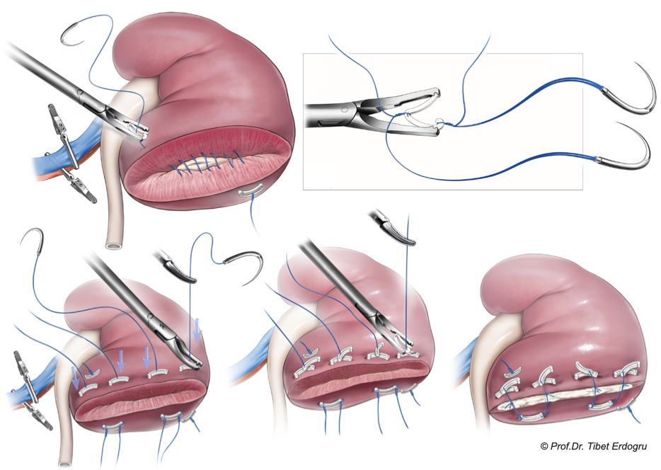 Partial Nephrectomy: Nephron-Sparing Surgery