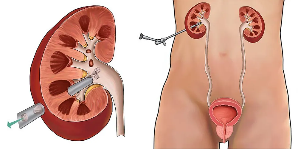 Percutaneous Kidney Surgery (PNL): Effective Solution for Large Stones