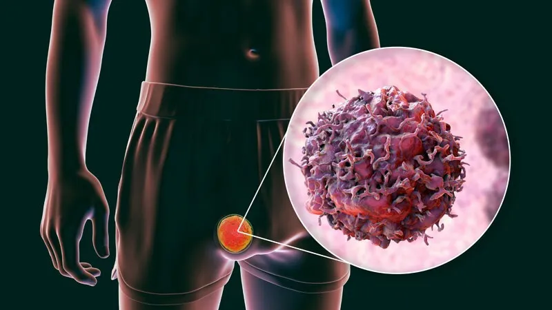 Testis kanseri belirtileri tanı ve tedavisi