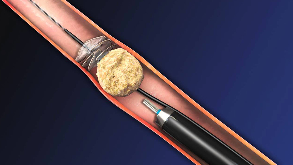Ureteroscopic Stone Surgery (URS/RIRS): Incision-Free Stone Treatment