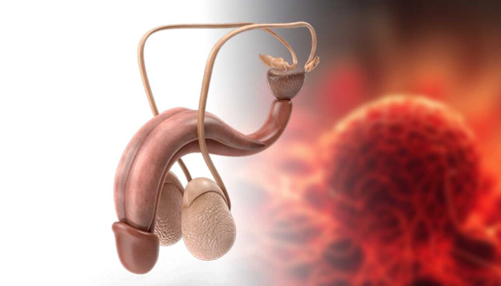 Prostate Cancer Treatment - Robotic Surgery